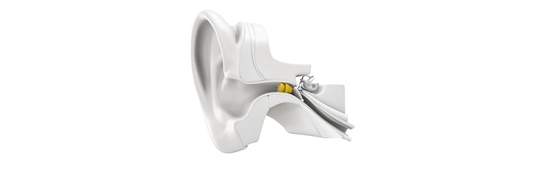 Lyric hearing aids