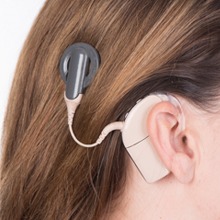 Cochlear Implant