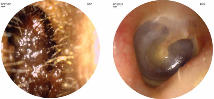 Before and after ear wax microsuction